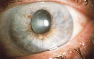 glaucoma big 1