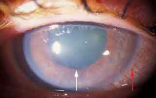 glaucoma big1