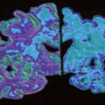alzheimer big1
